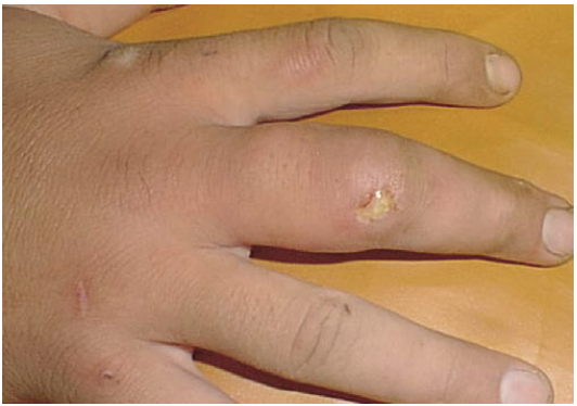 Нарывает палец возле ногтя: лечение паронхии